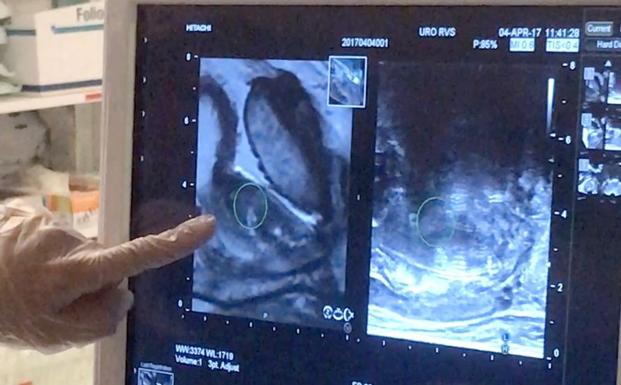 aguja de biopsia de próstata 4k